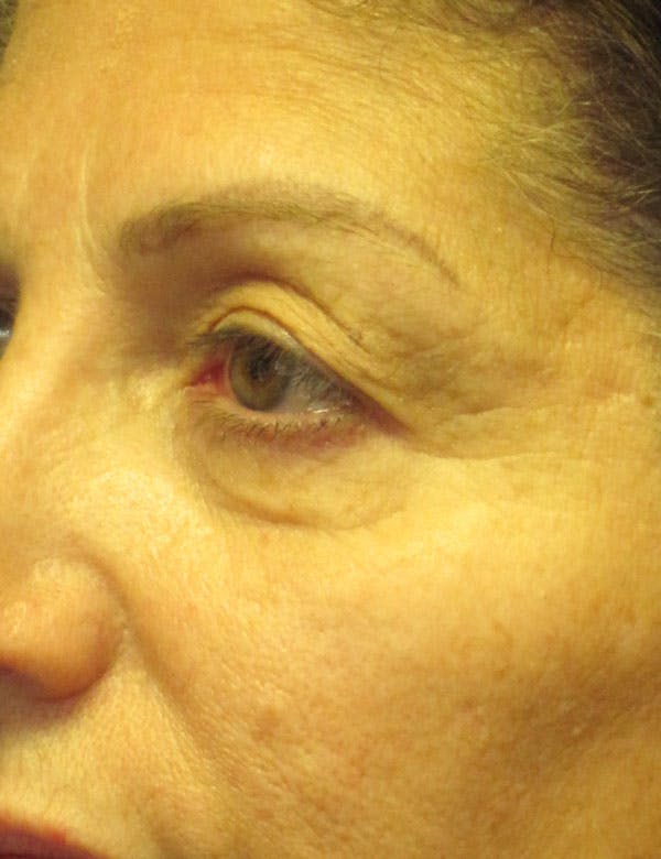 Blepharoplasty Before & After Gallery - Patient 4883053 - Image 3