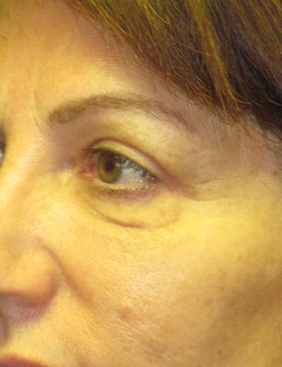 Blepharoplasty Before & After Gallery - Patient 4883053 - Image 4