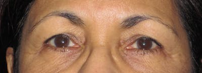 Blepharoplasty Before & After Gallery - Patient 4883060 - Image 1