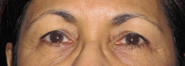 Blepharoplasty Before & After Gallery - Patient 4883060 - Image 1