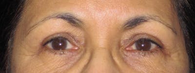 Blepharoplasty Before & After Gallery - Patient 4883060 - Image 2