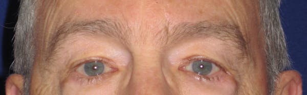 Blepharoplasty Before & After Gallery - Patient 4883067 - Image 1
