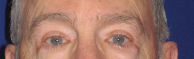 Blepharoplasty Before & After Gallery - Patient 4883067 - Image 2