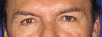 Blepharoplasty Before & After Gallery - Patient 4883072 - Image 1