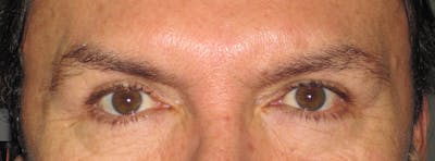 Blepharoplasty Before & After Gallery - Patient 4883072 - Image 2
