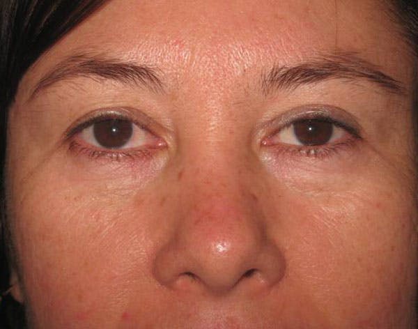 Blepharoplasty Before & After Gallery - Patient 4883076 - Image 1