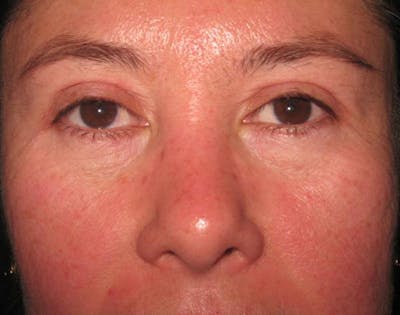 Blepharoplasty Before & After Gallery - Patient 4883076 - Image 2