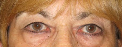 Blepharoplasty Before & After Gallery - Patient 4883080 - Image 1