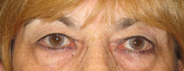 Blepharoplasty Before & After Gallery - Patient 4883080 - Image 1