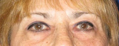 Blepharoplasty Before & After Gallery - Patient 4883080 - Image 2