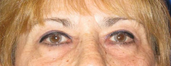 Blepharoplasty Before & After Gallery - Patient 4883080 - Image 2