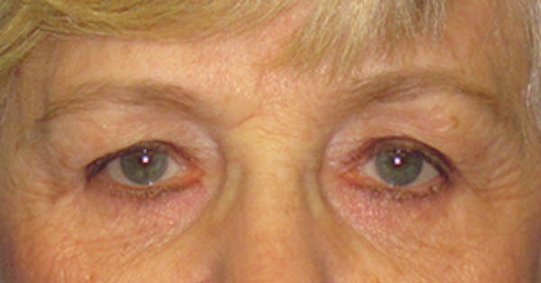 Blepharoplasty Before & After Gallery - Patient 4889460 - Image 1