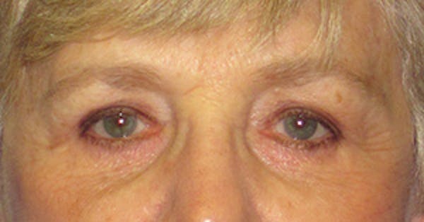 Blepharoplasty Before & After Gallery - Patient 4889460 - Image 2