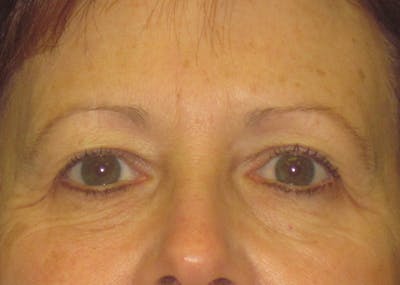 Blepharoplasty Before & After Gallery - Patient 4889465 - Image 1
