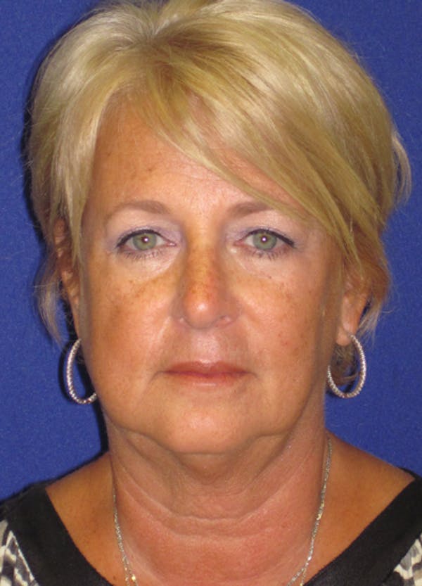 Facelift/Mini-Facelift Before & After Gallery - Patient 4889620 - Image 1