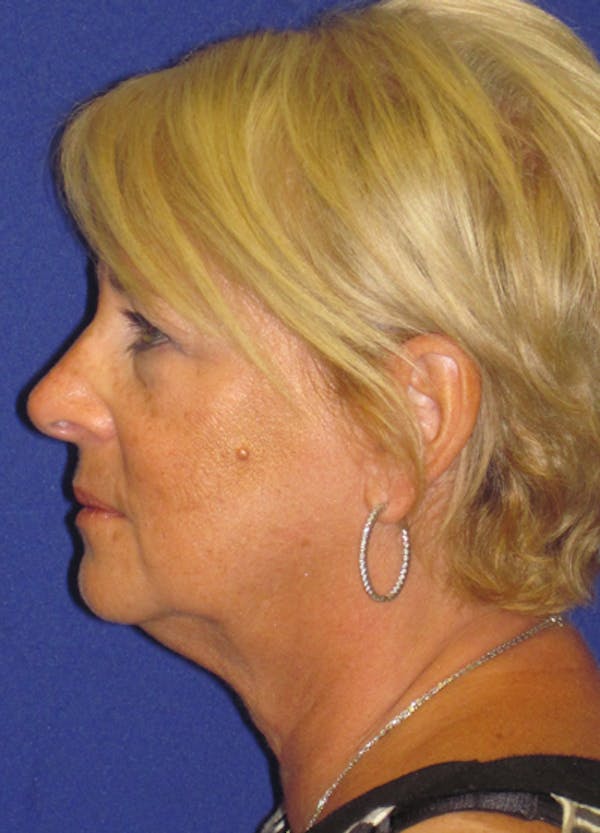 Facelift/Mini-Facelift Before & After Gallery - Patient 4889620 - Image 5