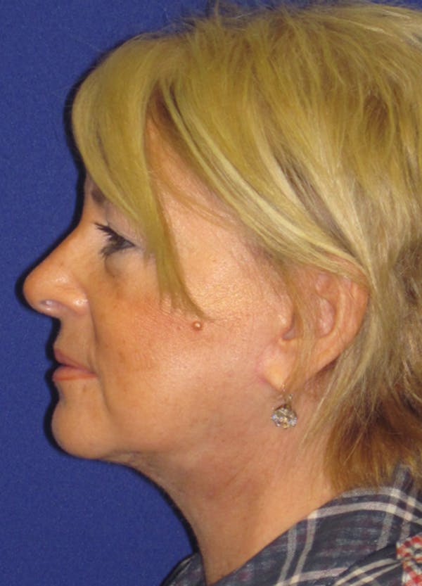 Facelift/Mini-Facelift Before & After Gallery - Patient 4889620 - Image 6
