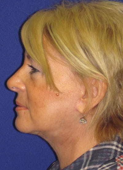 Facelift/Mini-Facelift Before & After Gallery - Patient 4889620 - Image 6