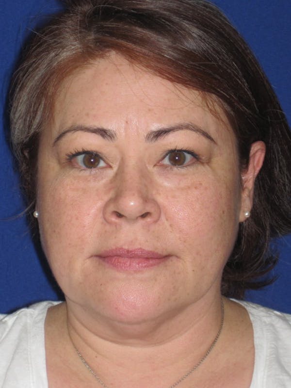 Facelift/Mini-Facelift Before & After Gallery - Patient 4889625 - Image 1