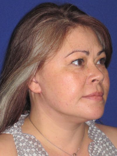 Facelift/Mini-Facelift Before & After Gallery - Patient 4889625 - Image 4