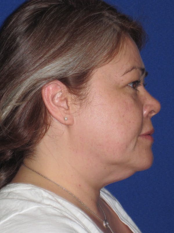 Facelift/Mini-Facelift Before & After Gallery - Patient 4889625 - Image 5