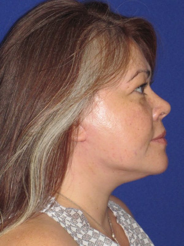 Facelift/Mini-Facelift Before & After Gallery - Patient 4889625 - Image 6