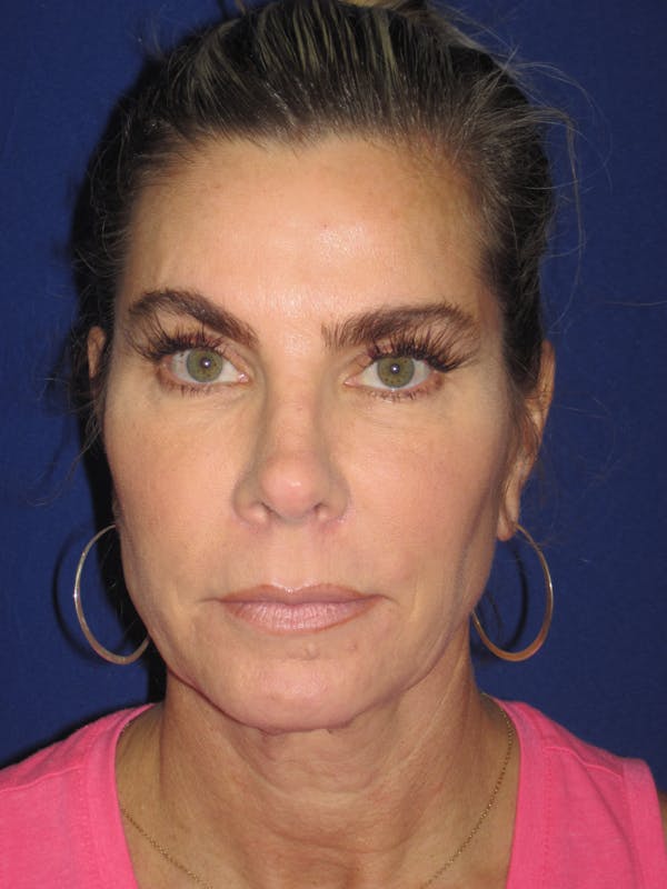 Facelift/Mini-Facelift Before & After Gallery - Patient 4889630 - Image 1