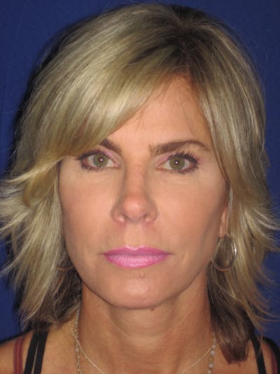 Facelift/Mini-Facelift Before & After Gallery - Patient 4889630 - Image 2