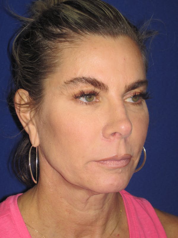 Facelift/Mini-Facelift Before & After Gallery - Patient 4889630 - Image 3