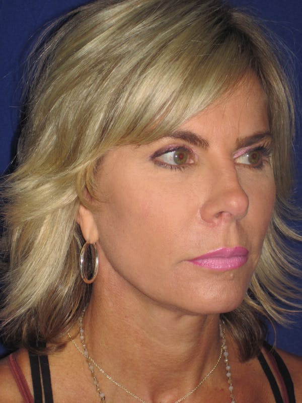 Facelift/Mini-Facelift Before & After Gallery - Patient 4889630 - Image 4