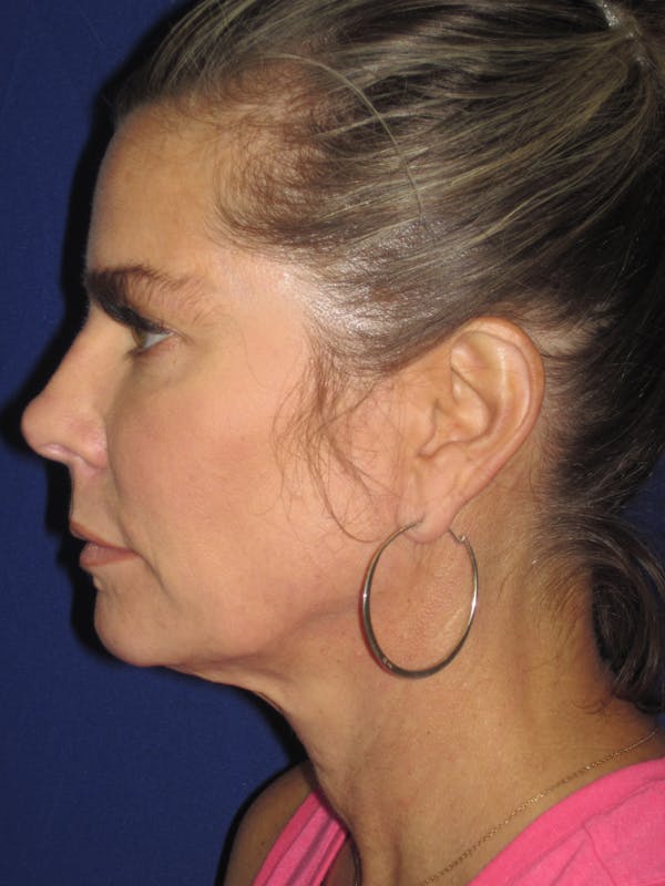 Facelift/Mini-Facelift Before & After Gallery - Patient 4889630 - Image 5