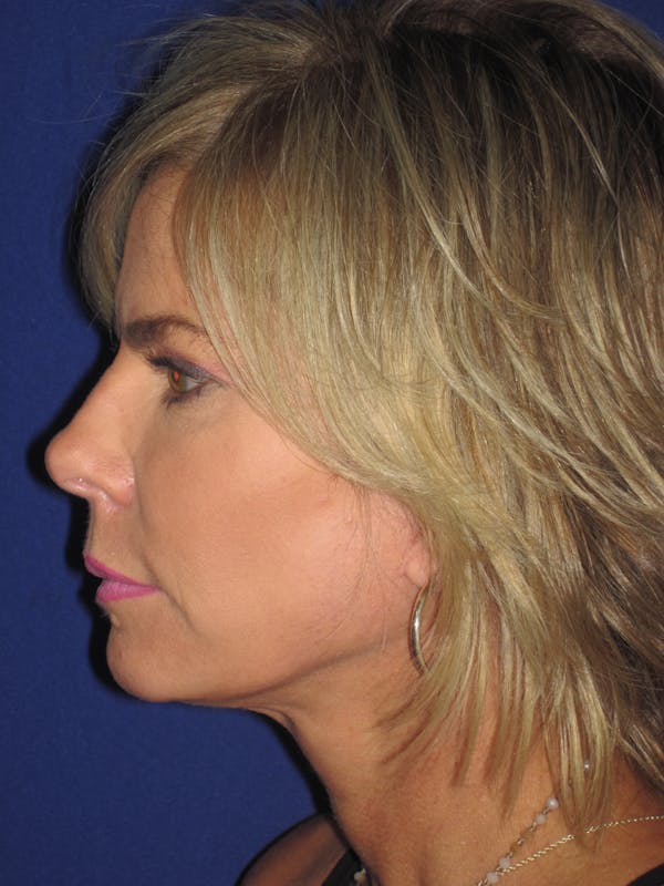 Facelift/Mini-Facelift Before & After Gallery - Patient 4889630 - Image 6