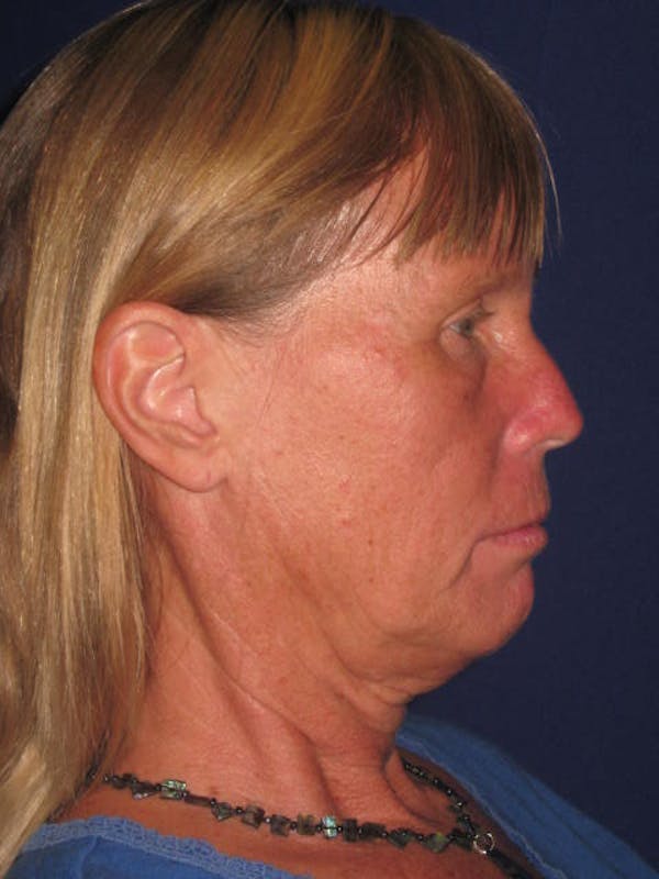 Facelift/Mini-Facelift Before & After Gallery - Patient 4889639 - Image 5
