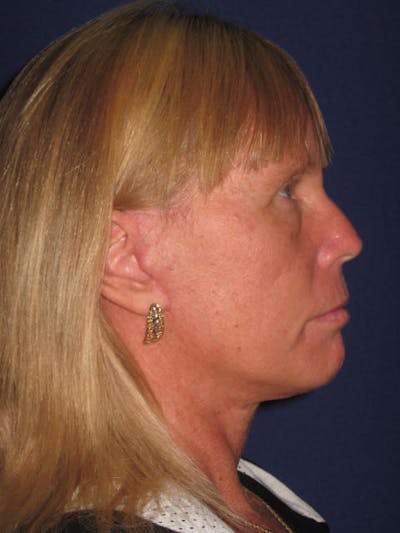 Facelift/Mini-Facelift Before & After Gallery - Patient 4889639 - Image 6