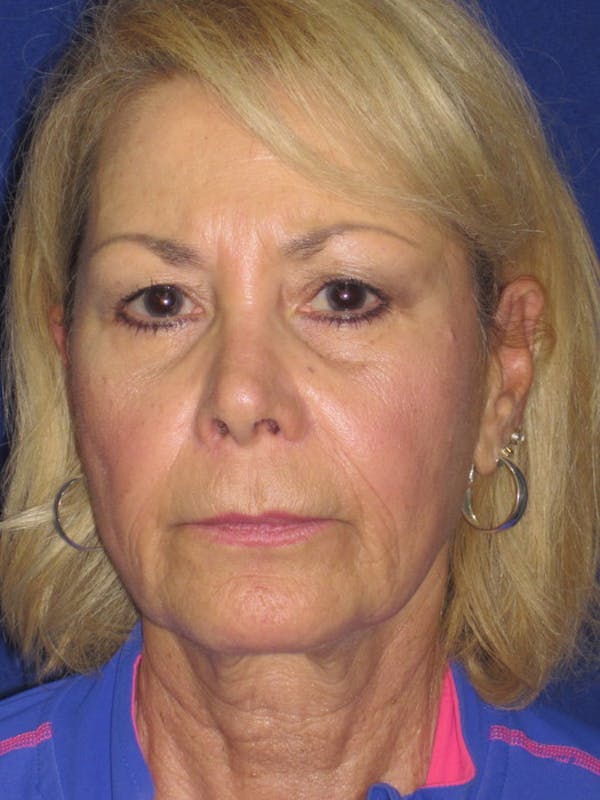Facelift/Mini-Facelift Before & After Gallery - Patient 4889646 - Image 3
