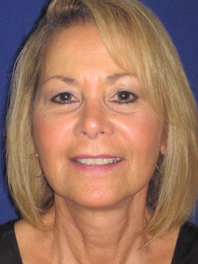 Facelift/Mini-Facelift Before & After Gallery - Patient 4889646 - Image 4