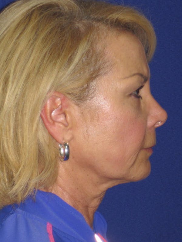 Facelift/Mini-Facelift Before & After Gallery - Patient 4889646 - Image 5