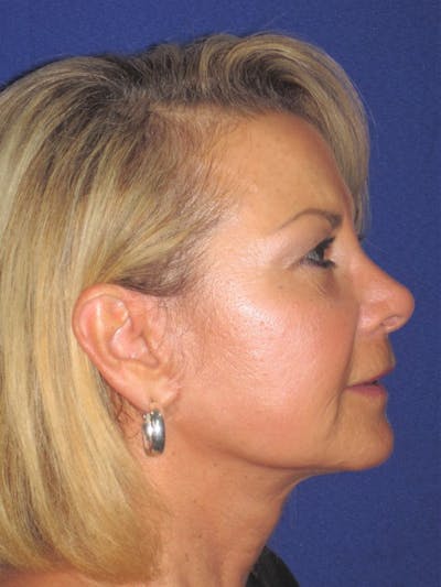 Facelift/Mini-Facelift Before & After Gallery - Patient 4889646 - Image 6