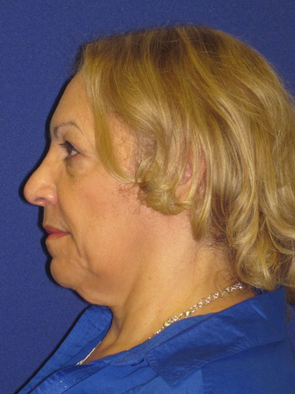 Facelift/Mini-Facelift Before & After Gallery - Patient 4889665 - Image 5