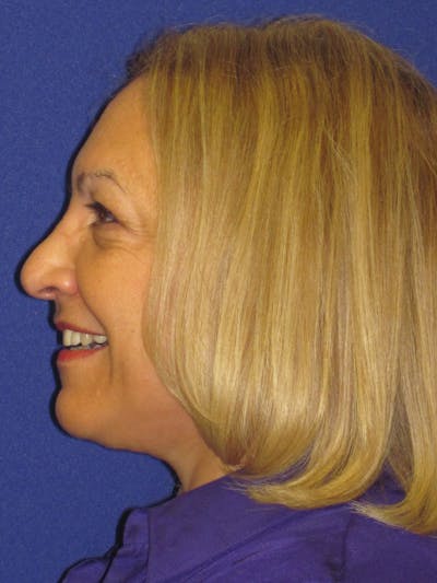 Facelift/Mini-Facelift Before & After Gallery - Patient 4889665 - Image 6