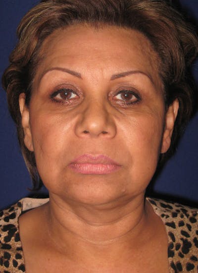 Facelift/Mini-Facelift Before & After Gallery - Patient 4889669 - Image 1