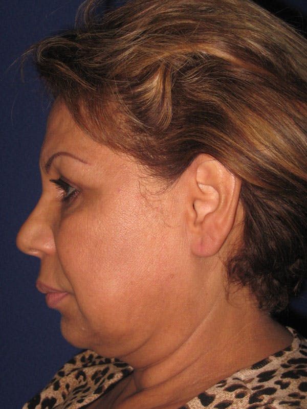 Facelift/Mini-Facelift Before & After Gallery - Patient 4889669 - Image 3