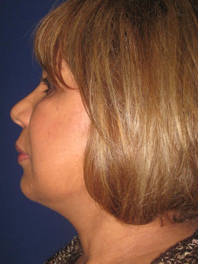 Facelift/Mini-Facelift Before & After Gallery - Patient 4889669 - Image 4