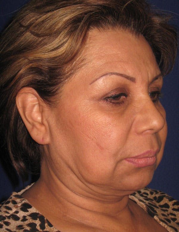 Facelift/Mini-Facelift Before & After Gallery - Patient 4889669 - Image 5