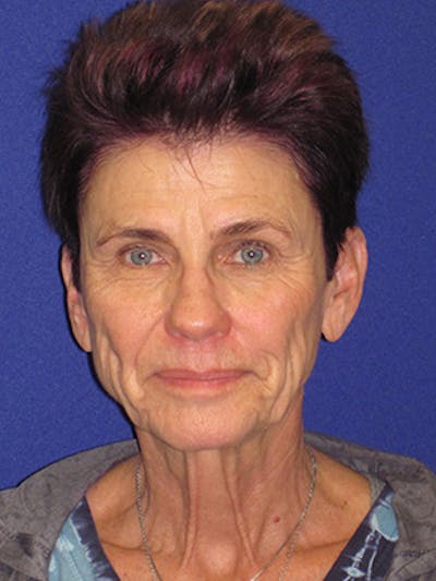 Facelift/Mini-Facelift Before & After Gallery - Patient 4889805 - Image 1