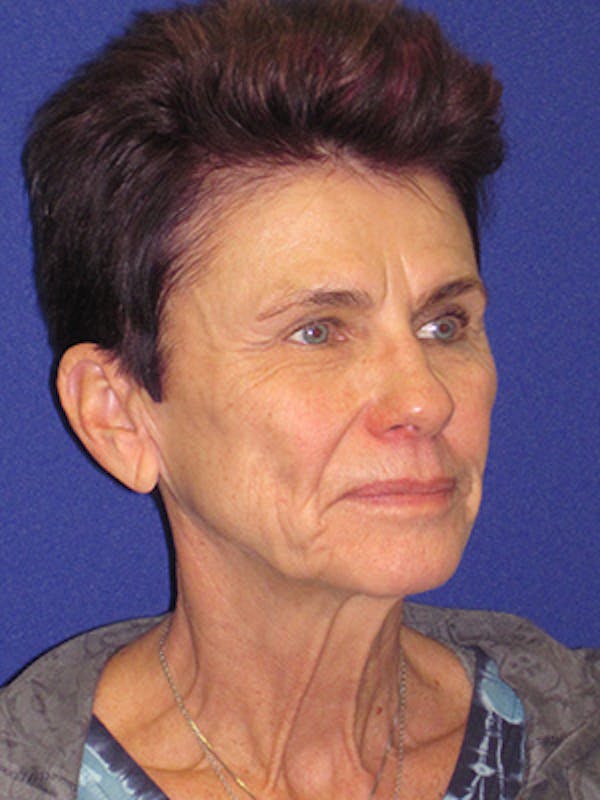 Facelift/Mini-Facelift Before & After Gallery - Patient 4889805 - Image 3