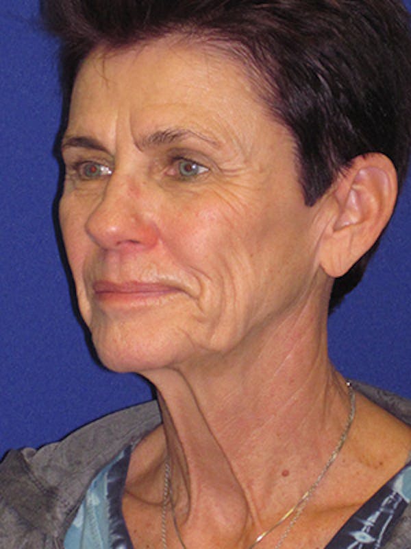 Facelift/Mini-Facelift Before & After Gallery - Patient 4889805 - Image 5