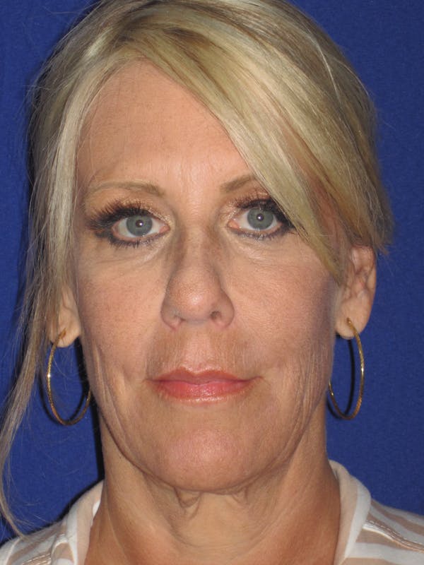 Facelift/Mini-Facelift Before & After Gallery - Patient 4889843 - Image 1