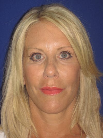 Facelift/Mini-Facelift Before & After Gallery - Patient 4889843 - Image 2