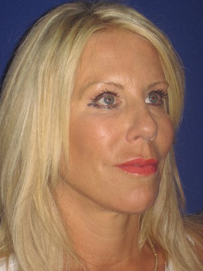 Facelift/Mini-Facelift Before & After Gallery - Patient 4889843 - Image 4